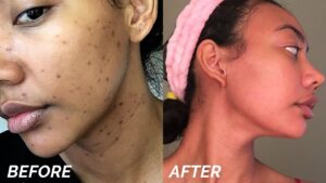 spotless puls acne cream, acne remover