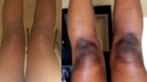D&R Knee and Elbow Lightening Cream - Before and after